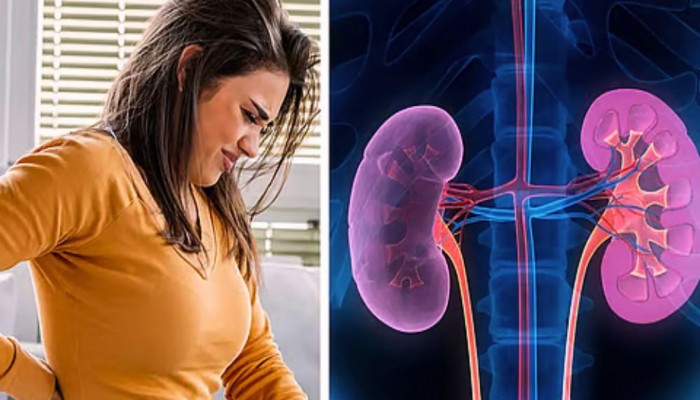 কিডনিতে পাথর প্রতিরোধের সহজ উপায়